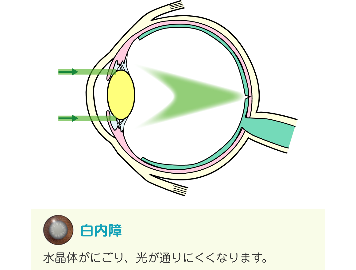 白内障