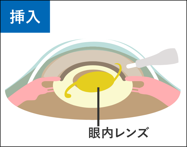 挿入